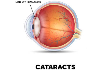 Have You Been Diagnosed with Cataracts?