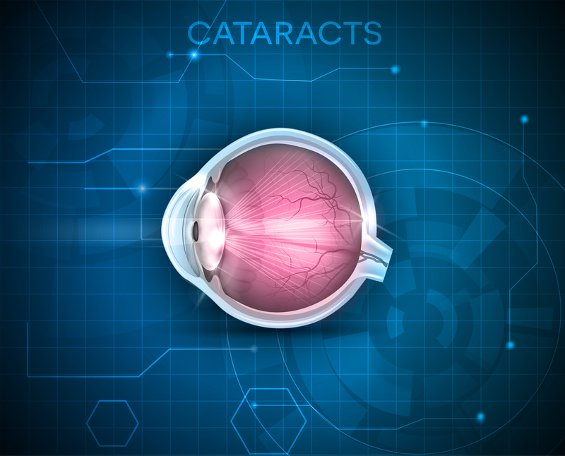 Cataracts and Modern Surgery: Clear Vision with Eye Center South